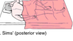 Sim Potition Patient Positioning: Importance, Techniques, and Safety Considerations ...