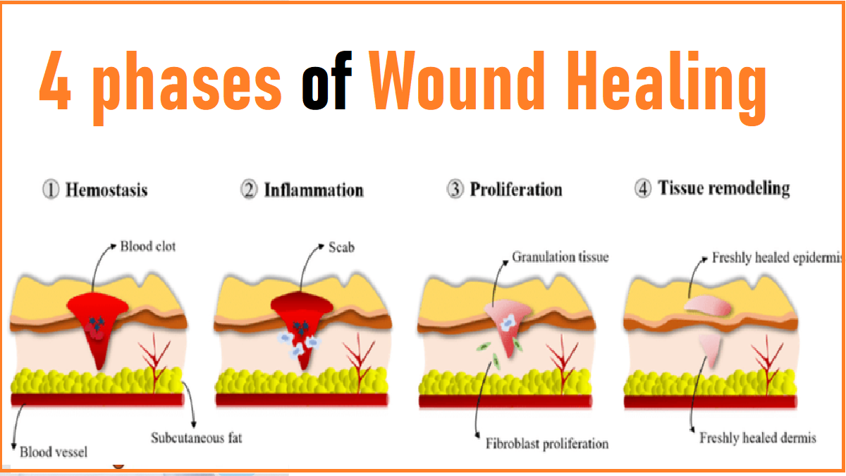 What Is The Correct Sequence For Wound Healing at Ronald Piper blog